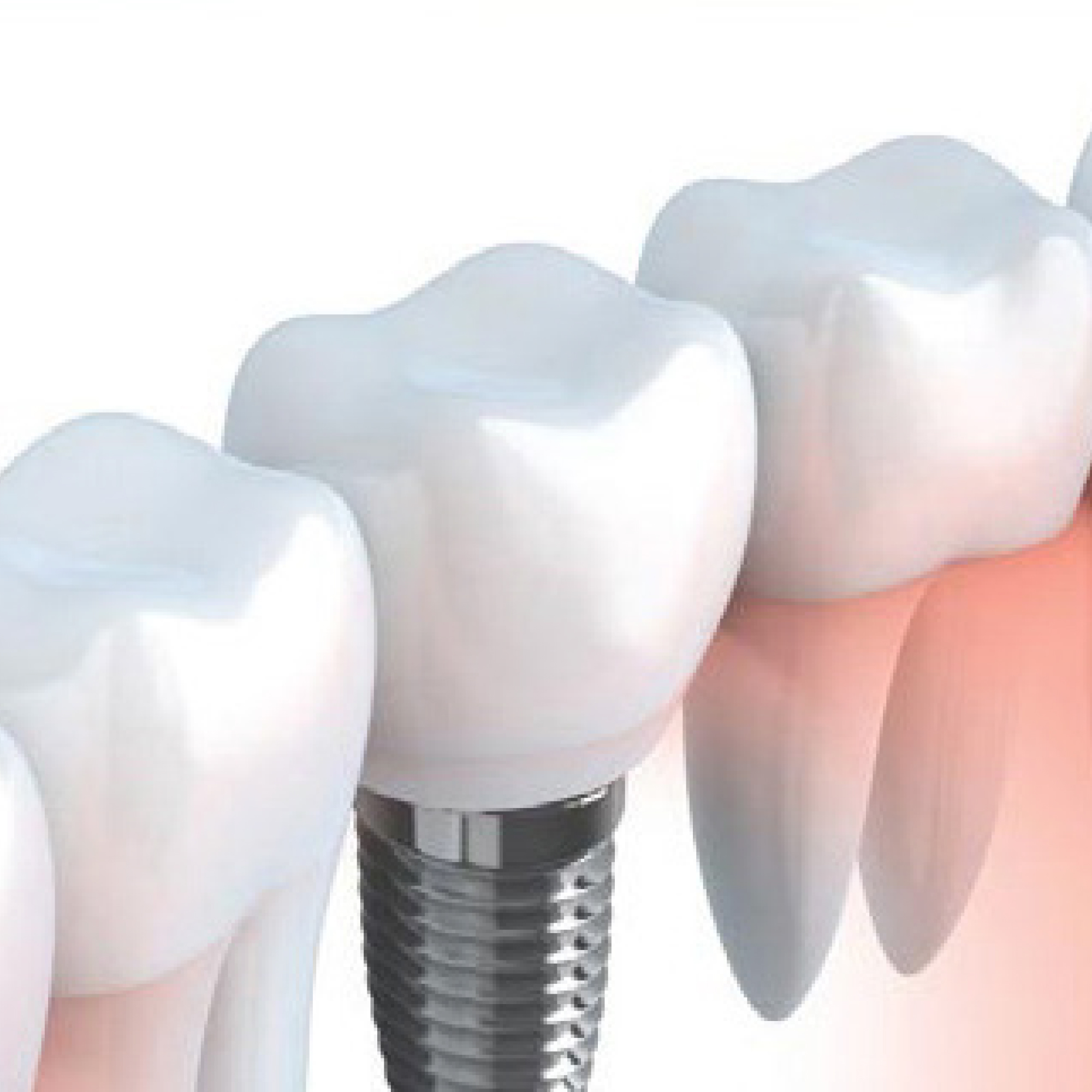 Fogorvosi Rendelő/ENDODONTIA/Endodontie Csontok